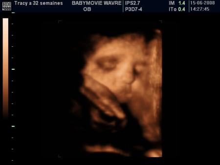 Voici une echographie 3d de ma petite tracy